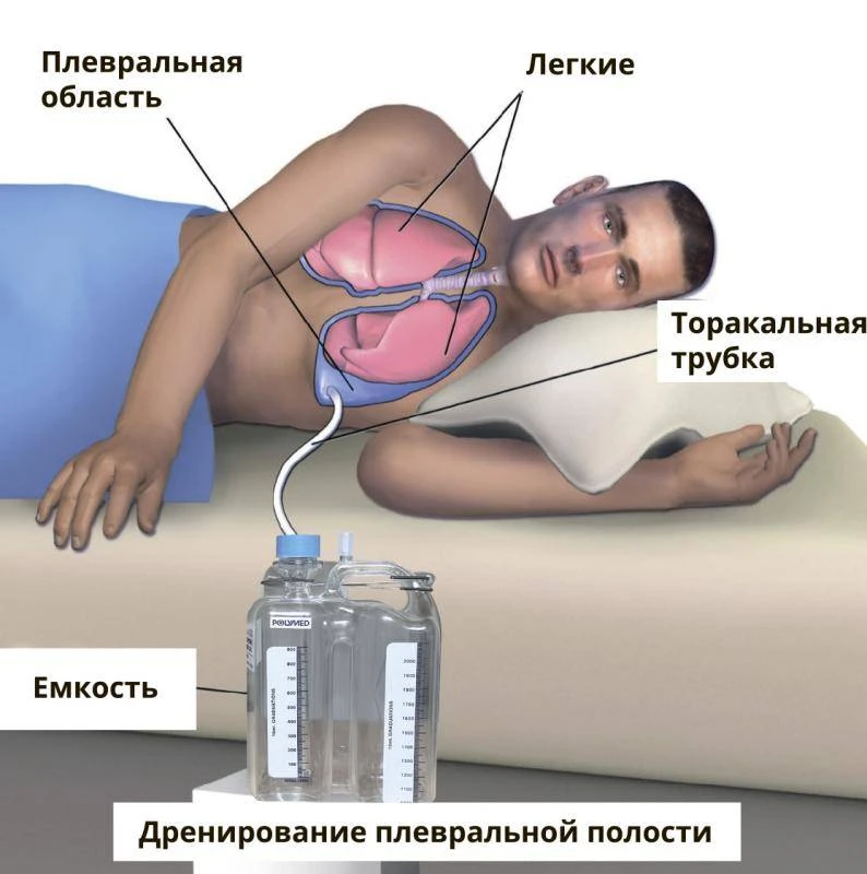 Изделия для дренирования плевральной полости