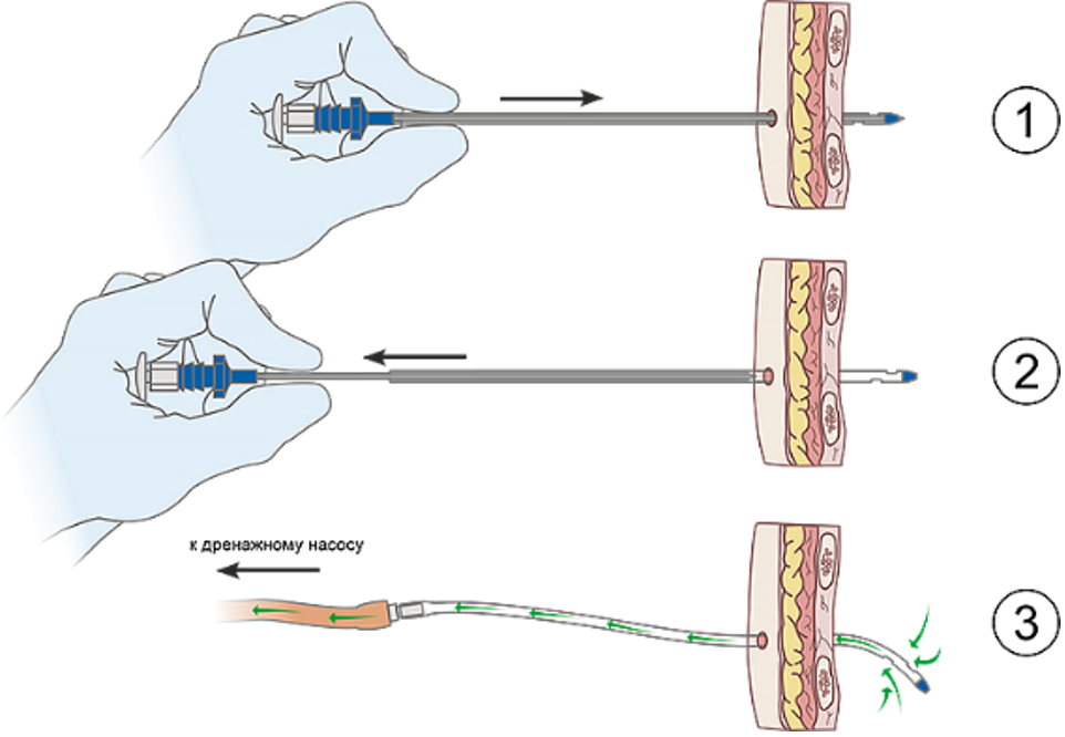 Изделия для дренирования плевральной полости