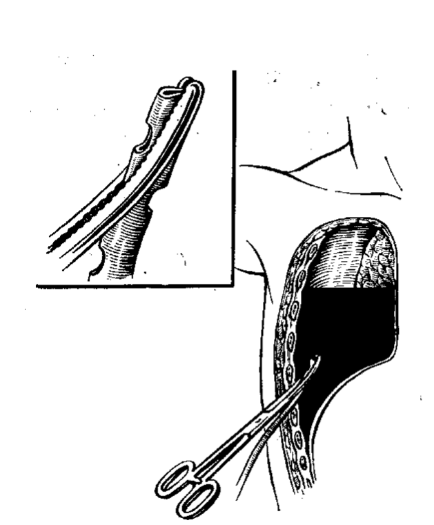 Изделия для дренирования плевральной полости