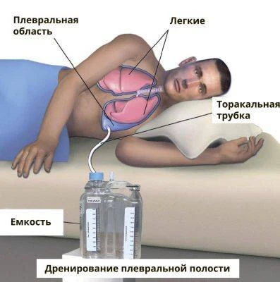 Изделия для дренирования плевральной полости